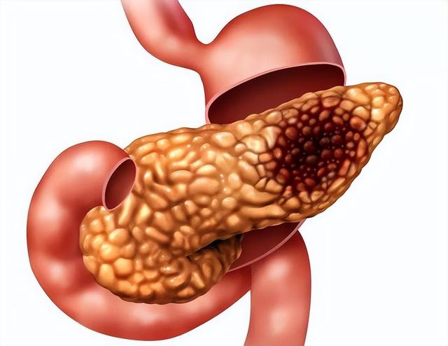 人体的胰腺在哪个位置图片（胰腺在人体哪个位置图）